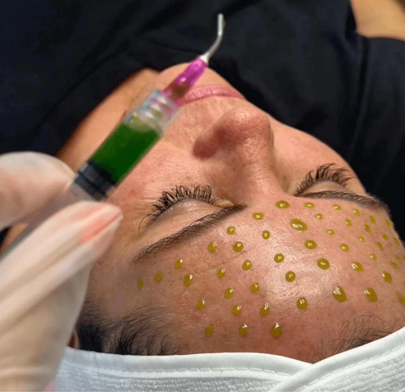 BioRePeel treatment at D-Essence Wellness